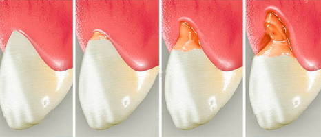 Клиновидный дефект зуба - картинка